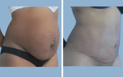 Before and After
